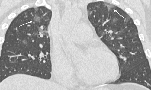 Figure 7: GGO with rounded morphology, both upper lobes