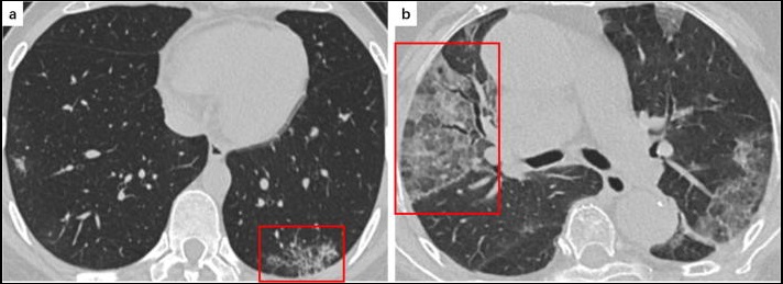 Figure 4: (a) Right lower lobe GGO, 35 year old COVID-19 male