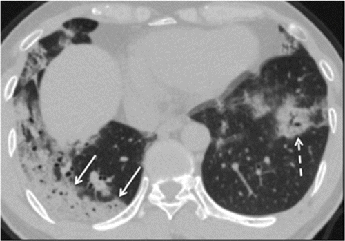 Figure 10: Baseline and follow-up CT lung parenchyma degradation