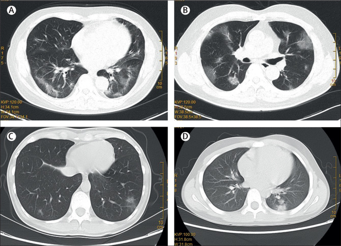 Figure 6: Thoracic CT multifocal ground-glass changes (4 patients)