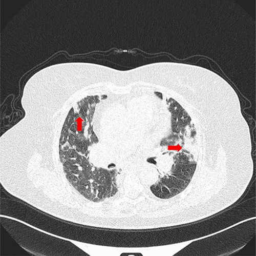Figure 1: High-resolution chest CT scan of a 60 year old female
