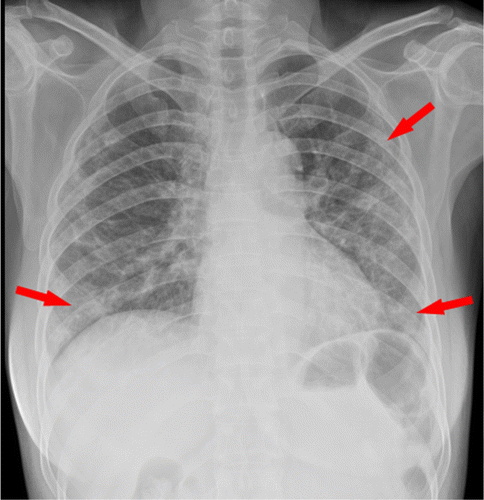 Figure 2: Chest radiography multifocal patchy opacities both lungs