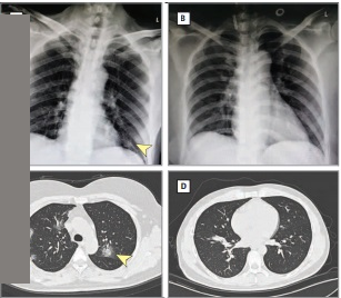 Figure 3: Chest radiograph and CT panels (A-D)