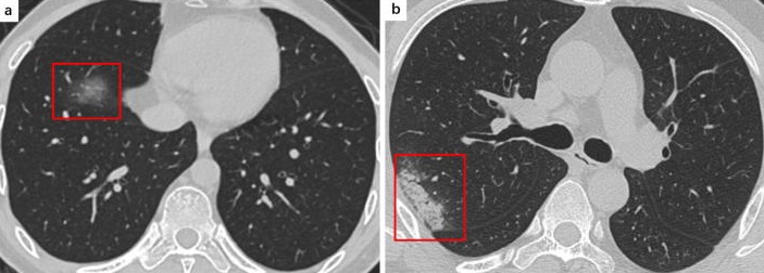 Figure 4: (b) Consolidation with air bronchograms, COVID-19 male