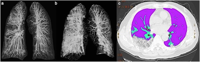 Figure 11: Follow-up CT severe pneumonia / pleural effusion