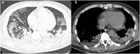 Figure 9: Axial CT bilateral consolidative opacities day 10